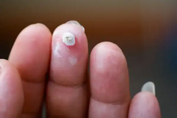 Image of white wart before cryopen treatment Fulham