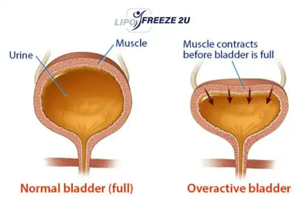 diagram of overactive bladder treatment Fulham