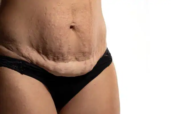 loose skin after weight loss injections Fulham
