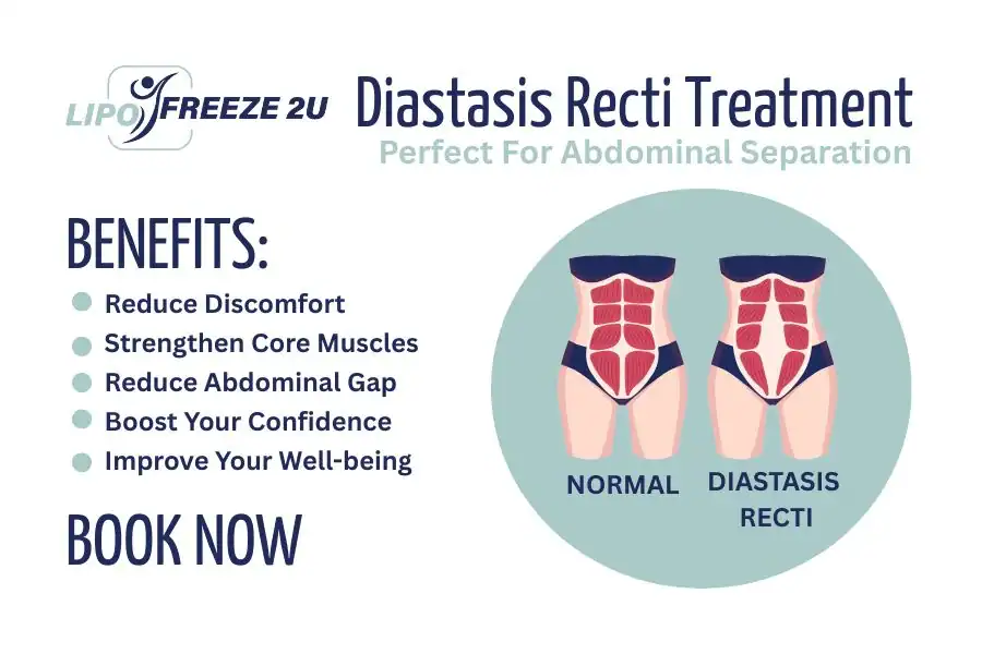 Benefits of body toning treatment Fulham for Diastasis recti