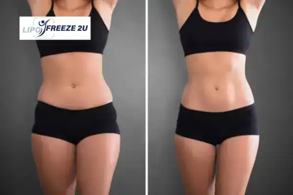 How Can LIPO FREEZE 2U Support Your Post-Pregnancy Body Recovery Fulham?