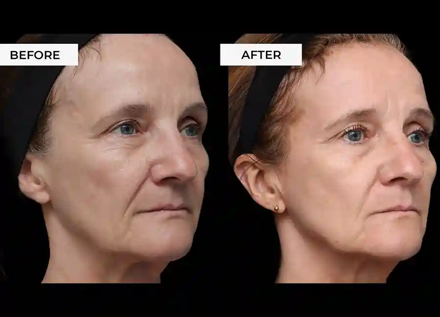 How Many RF Microneedling Sessions Will You Need to See a Difference Fulham?