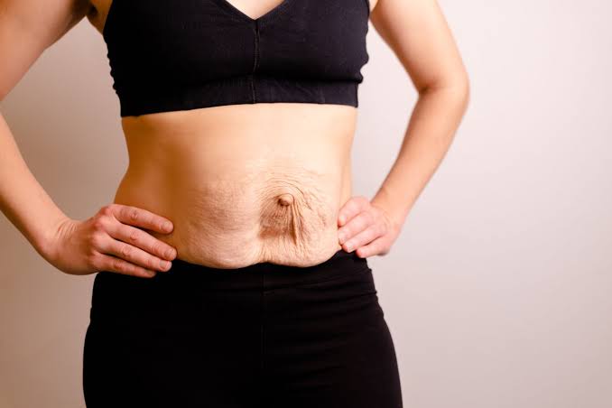 Is Surgery Really the Only Way to Repair Diastasis Recti Fulham?