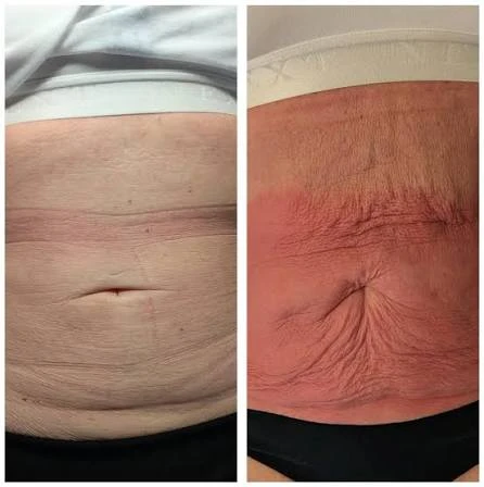 How Does RF Microneedling Improve Crepey, Thin and Uneven Skin Texture Fulham?