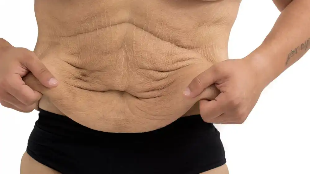 Why Does Weight Loss Medication Leave Some People With Loose or Sagging Skin Fulham?